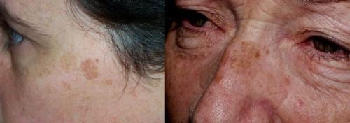 Как убрать возрастные пигментные пятна. Что такое пигментные пятна? 02