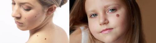 Как убрать возрастные пигментные пятна. Что такое пигментные пятна? 03