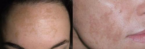 Как убрать возрастные пигментные пятна. Что такое пигментные пятна? 01