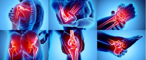 Артрит или артроз: разбираемся в различиях 02