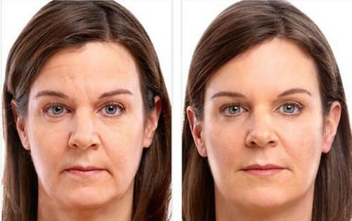 Как выбрать подходящего специалиста для инъекции ботокса в подбородок