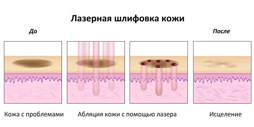 Какие риски и побочные эффекты могут быть при фракционном лазерном омоложении лица
