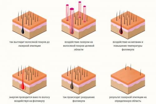 Как часто выпадают волосы после лазерной эпиляции